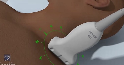 Interscalene Nerve Block