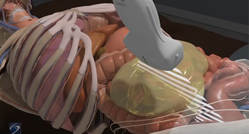 Ultrasound Guided Paracentesis