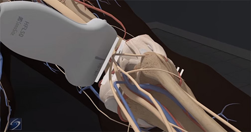 Popliteal Sciatic Nerve Block