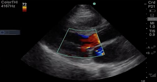 valvular assessment