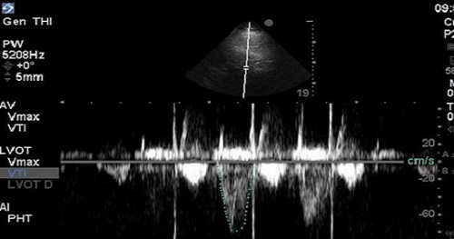 Stroke Volume