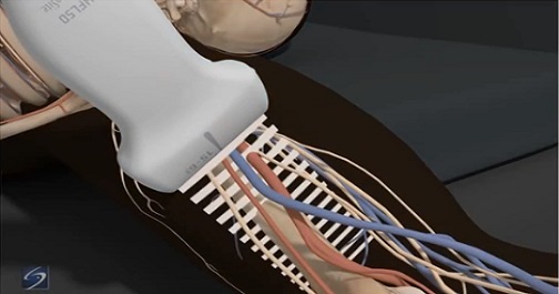 Ultrasound-Guided Peripheral IV Access Hero Image